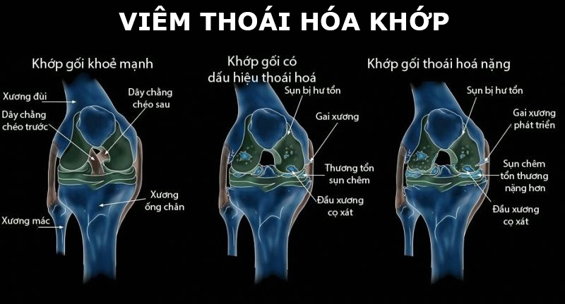 Bệnh viêm khớp gối