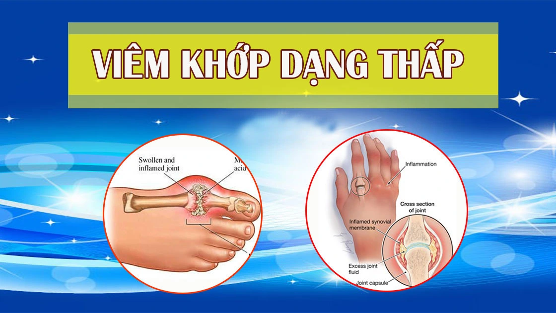 Triệu chứng viêm khớp thấp
